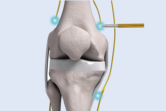 ラジオ波焼灼療法のイメージ図